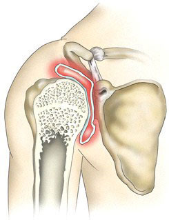 Лечение артрита плечевого сустава народными средствами