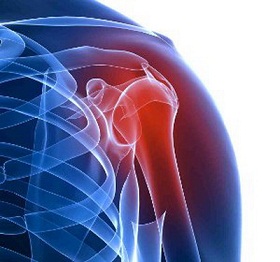Лечение артрита плеча