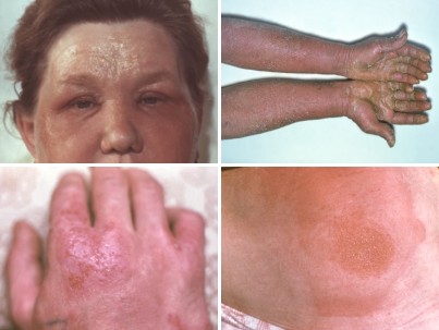 Аллергический дерматит, фото болезни