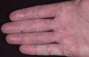 Аллергический дерматит на ладони