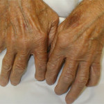 Артрит пальцев рук, лечение