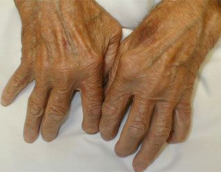 Артрит пальцев рук, признаки и лечение