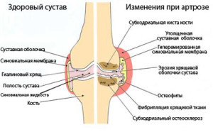 artroz-kolennogo-sustava-simptomi11