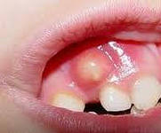 Причины и симптомы зубного флюса