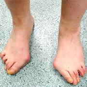 Артроз пальцев ног. Диагностируем и лечим грамотно