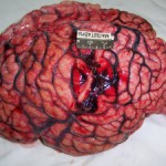 Отек головного мозга: симптомы и лечение