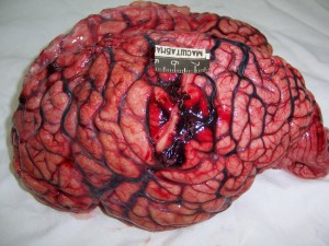Отек головного мозга: симптомы и лечение