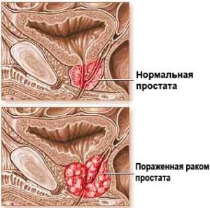 Стадии рака предстательной железы 