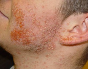 Фото 1 - гнойничковое заболевание кожи (пиодермия)