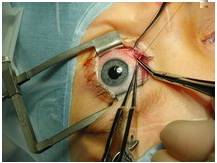 Хирург исправляет косметический дефект, но не вернет остроту зрения
