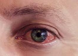 Многоликое воспаление роговицы глаз