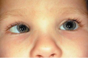 Смещение отражения в глазах младенца при сходящемся косоглазии