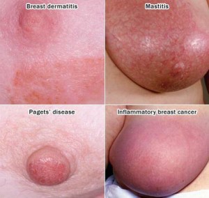 Triple-Negative-Breast-Cancer1 (1)