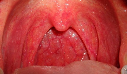 Болезни горла симптомы