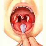 Симптомы заболевания горла