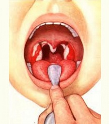 Симптомы заболевания горла