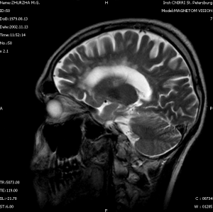 Лечение отек головного мозга 