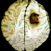 Признаки рака головного мозга на фото