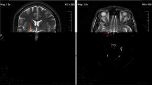 Рентгеновский снимок - рак мозга