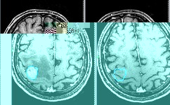 Рентгеновский снимок и рак мозга