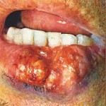 Рак губы первые признаки