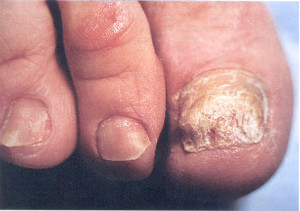 Грибок ногтя на ноге, симптомы