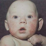 Аллергия у ребенка фото