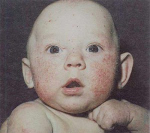 Аллергия у ребенка  на фото