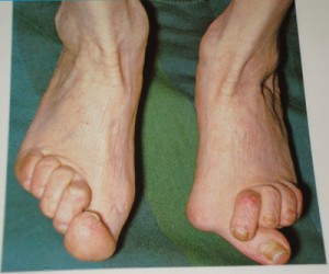Артрит большого пальца ноги на фото