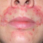 Дерматит аллергический: симптомы и фото