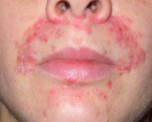 Симптомы аллергического дерматита