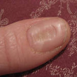 Заболевания ногтей на руках фото