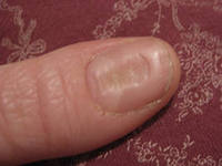 Болезнь ногтей фото
