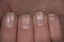 На фото болезнь ногтей на руках 