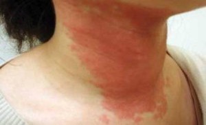 allergic_contact_dermatitis