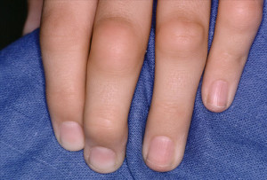 Воспаление суставов пальцев рук на фото