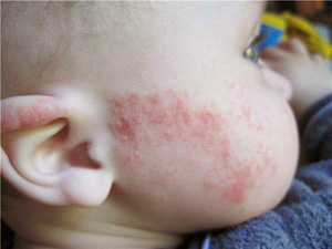 Аллергический дерматит у детей на фото