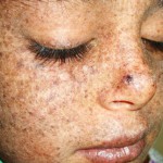 Как начинается рак кожи