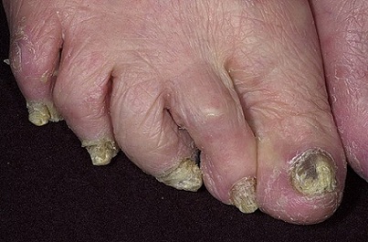 Фото ногтей на ногах с грибком