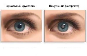  Причины и симптомы катаракты