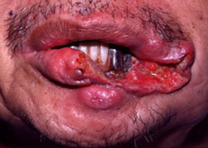 Признаки рака губы