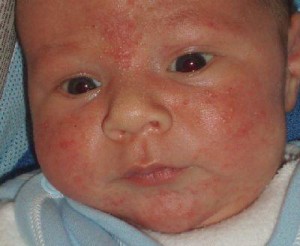 На фото аллергический дерматит у детей