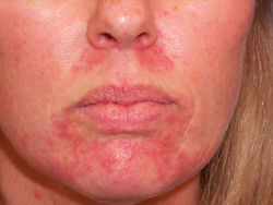Атопический дерматит - Кожные заболевания на лице