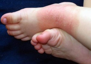 Нейродерматит на детских ножках