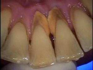 Пародонтоз гнилые зубы