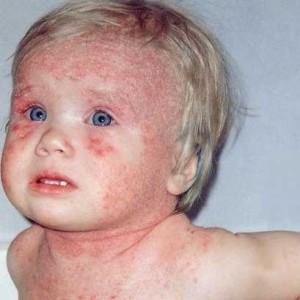 себорейный дерматит у детей