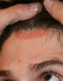 себорейный дерматит у линии волос