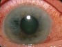 Симптомы заболевания глаукома