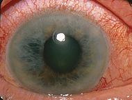 Болезнь глаз - глаукома