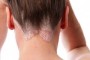 Как лечить псориаз волосистой части головы?